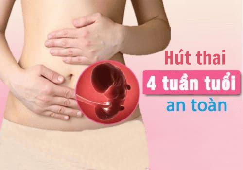 Hút thai 4 tuần có an toàn không? - Quy trình hút thai 4 tuần tuổi